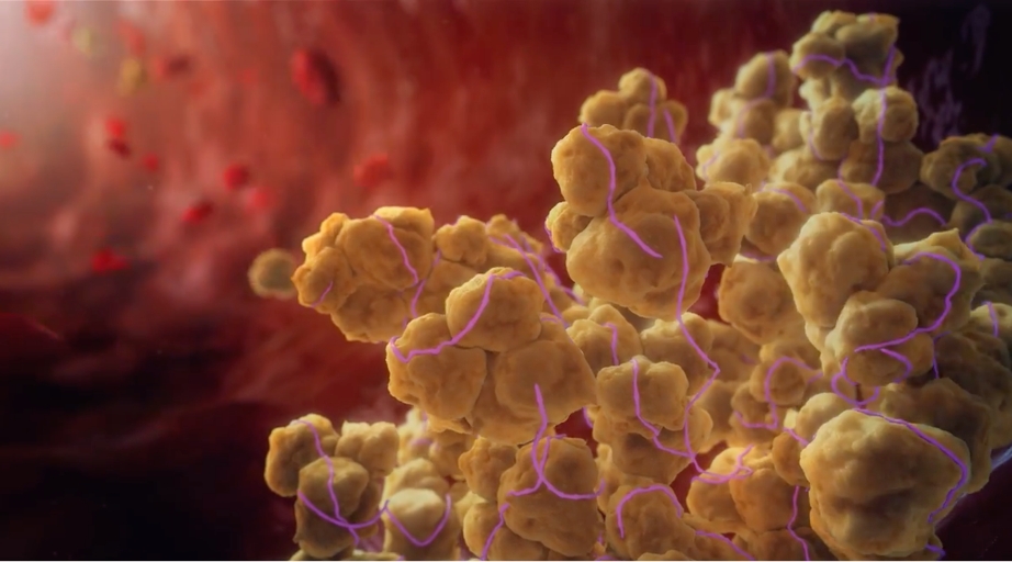 ttp_pathophysiology_video